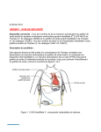 Dispositif d`assistance ventriculaire gauche HeartMate II
