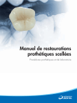 Pilier CastDesign - DENTSPLY Implants E