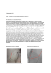Stents intracr&acirc;niens Pipeline - soci&eacute;t&eacute; Ev3 - Covidien